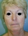 Female patient who underwent facial surgery 