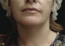 Ultherapy Neck