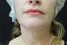 Ultherapy Neck