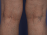 Laser Vein