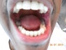 Dental Bridges & Whitening