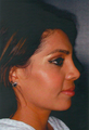 Septorhinoplasty