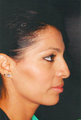 Septorhinoplasty