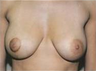 Breast Reduction