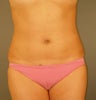 Liposuction