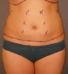 Liposuction