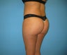 Brazilian buttock lift
