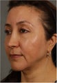 50 Year Old Female with jowls, neck laxity, and loss of volume in her cheeks 