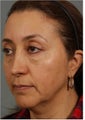 50 Year Old Female with jowls, neck laxity, and loss of volume in her cheeks 