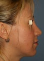 Rhinoplasty