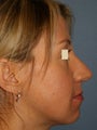 Rhinoplasty
