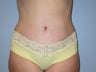 Tummy Tuck