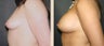 Breast Augmentation