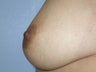 Nipple Surgery