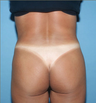 Liposuction Patient