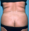 Liposuction Patient