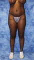Brazilian Butt Lift and creating curves