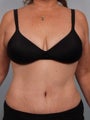 Tummy Tuck