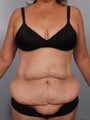 Tummy Tuck