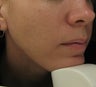 Acne Treatment