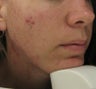 Acne Treatment