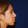 Revision Rhinoplasty