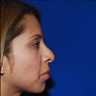 Revision Rhinoplasty
