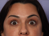 Botox to Forehead