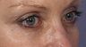 Eyelid Surgery