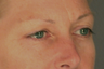 Eyelid Surgery