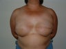 Breast Reconstruction