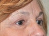 65 Year Old Female Treated For Brow Sagging and Severe Eyelid Skin Excess