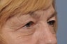 65 Year Old Female Treated For Brow Sagging and Severe Eyelid Skin Excess