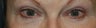 Blepharoplasty - Eyelid Lift