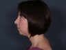 Chin Implant