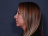 Chin Implant