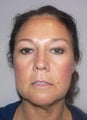 49 year old woman has Mini Facelift