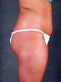 Liposuction of the Hips, Thighs, and Abdomen