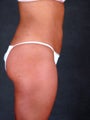 Liposuction of the Hips, Thighs, and Abdomen