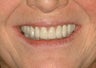 Full Mouth Reconstruction