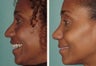 Attractive African American actress in her mid-twenties who felt her nose was larger than her other features