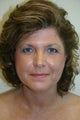 54 Year Old Female Neck Lift
