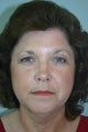 54 Year Old Female Neck Lift
