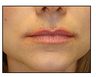 Injectables