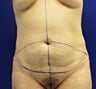 Tummy Tuck
