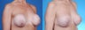 Revision Breast Surgery / Breast Implant Revision