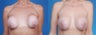 Revision Breast Surgery / Breast Implant Revision