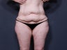 Body Lift