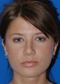 Rhinoplasty