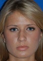 Rhinoplasty